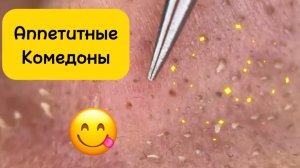 Чистка лица от угрей и акне. Выдавливание прыщей. Удаление черных точек и комедонов.