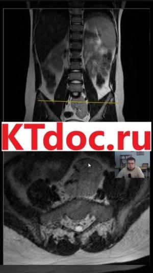 Тазовая_почка