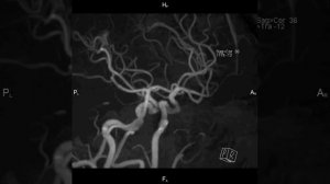 МР ангиография артерий головного мозга на МРТ 3,0 Tесла Siemens MAGNETOM Verio