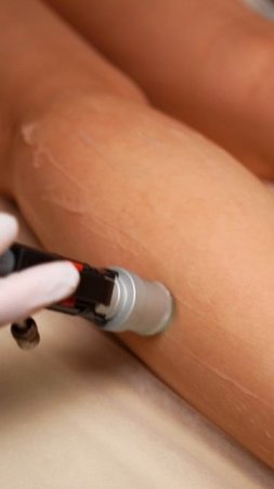 5 причин выбрать эпиляцию на Deka Motus AX Moveo в клинике «Гельтек»