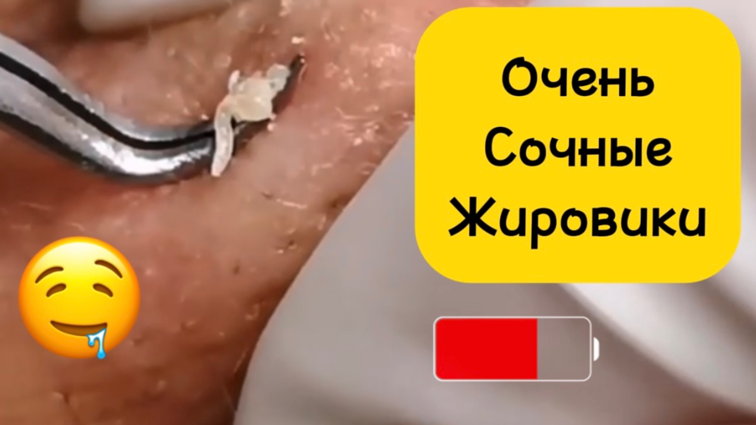 Чистка лица от угрей и акне. Выдавливание прыщей. Удаление черных точек и комедонов.