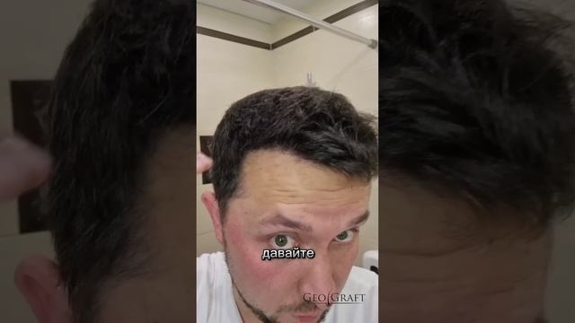 Мокрые и сухие волосы после пересадки волос, Географт #волосы