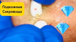 Чистка лица от угрей и акне. Выдавливание прыщей. Удаление черных точек и комедонов.