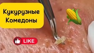 Чистка лица от угрей и акне. Выдавливание прыщей. Удаление черных точек и комедонов.