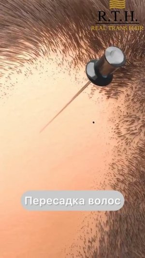 Чего вы еще не знаете о пересадке волос?