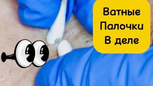 Чистка лица от угрей и акне. Выдавливание прыщей. Удаление черных точек и комедонов.
