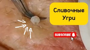 Чистка лица от угрей и акне. Выдавливание прыщей. Удаление черных точек и комедонов.