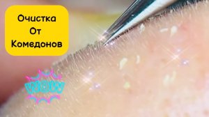 Чистка лица от угрей и акне. Выдавливание прыщей. Удаление черных точек и комедонов.