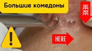 Чистка лица от угрей и акне. Выдавливание прыщей. Удаление черных точек и комедонов.
