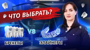 Брекеты или элайнеры? Что выбрать для исправления неправильного прикуса?