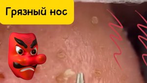 Чистка лица от угрей и акне. Выдавливание прыщей. Удаление черных точек и комедонов.