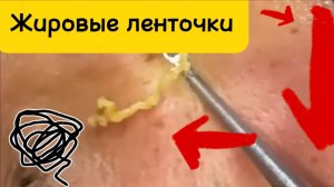 Чистка лица от угрей и акне. Выдавливание прыщей. Удаление черных точек и комедонов.