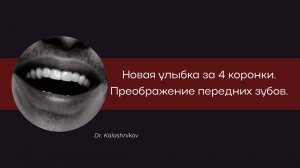 НОВАЯ УЛЫБКА ЗА 4 КОРОНКИ. ПРЕОБРАЖЕНИЕ ПЕРЕДНИХ ЗУБОВ.