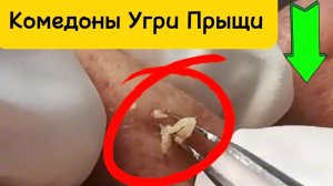 Чистка лица от угрей и акне. Выдавливание прыщей. Удаление черных точек и комедонов.
