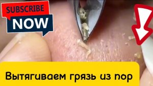 Чистка лица от угрей и акне. Выдавливание прыщей. Удаление черных точек и комедонов.
