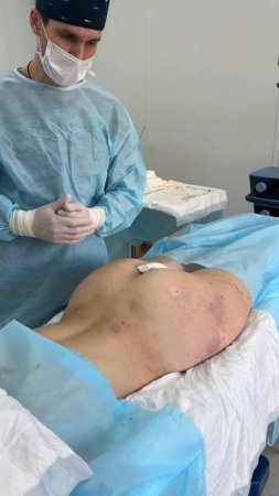 #липомоделирование: сразу после операции