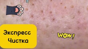 Чистка лица от угрей и акне. 
Выдавливание прыщей. Удаление черных точек и комедонов.