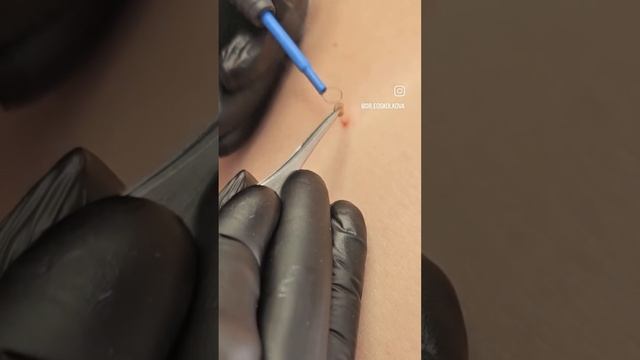 Зачем нужен первичный прием врача при удалении новообразований кожи