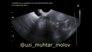 Пузырный занос — разновидность гестационной трофобластической болезни, при которой в полости матки