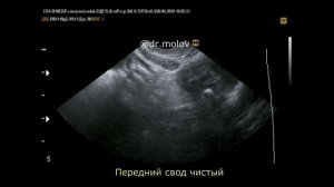 Глубокий инфильтрирующий эндометриоз