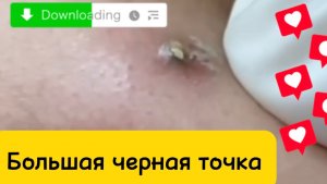 Чистка лица от угрей и акне. Выдавливание прыщей. Удаление черных точек и комедонов.