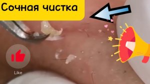 Чистка лица от угрей и акне. Выдавливание прыщей. Удаление черных точек и комедонов.