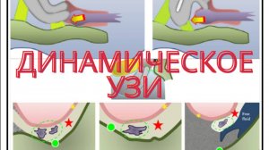 Динамическое УЗИ при эндометриозе