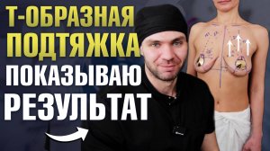 Выполняю Т-образную подтяжку груди. Якорная мастопексия | Пластический хирург Саввин Олег