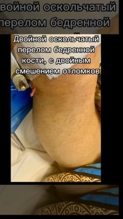 Мая часть травм полученных в ДТП с Фурой от 28.02.2025