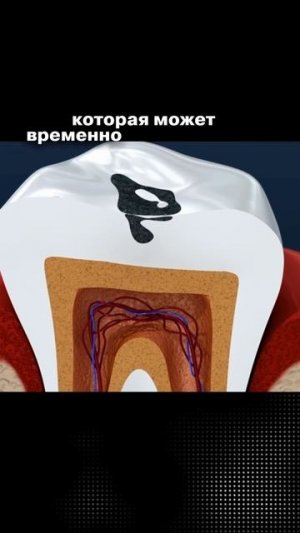 🦷 Зуб перестал болеть, радоваться или все-таки дойти до стоматолога?