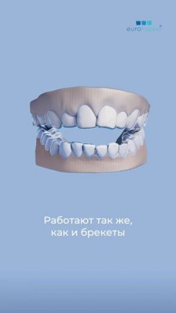 А что выбрали бы вы: брекеты или элайнеры? #еврокаппа #eurokappa #ортодонтическоелечение