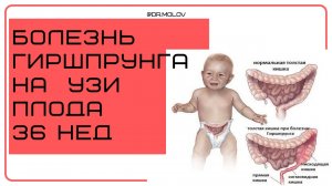 БН гиршпрунга ЮТ