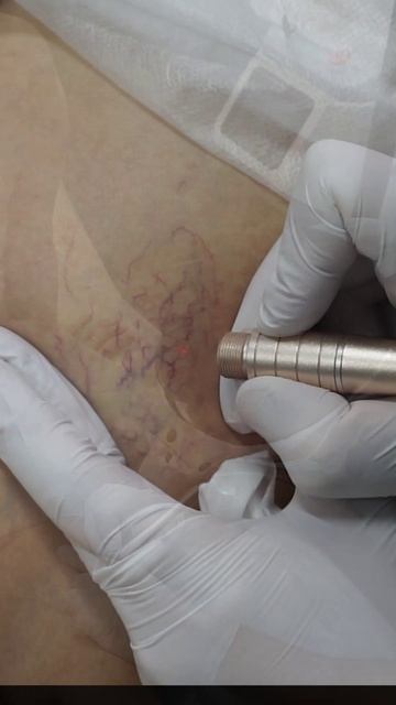 Удаление Сосудистой Сетки На Бедрах смотреть онлайн