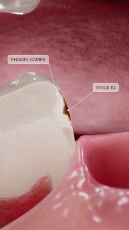 Что такое кариес зубов и как он развивается? Изучайте стоматологию в 3D