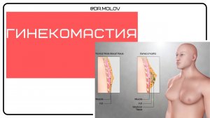 Гинекомастия 3 случая на УЗИ