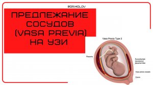 Предлежание сосудов плаценты
