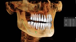 Отчет об автоматическом измерении цефалометриив ортодонтии MEC ‑3D MEYER