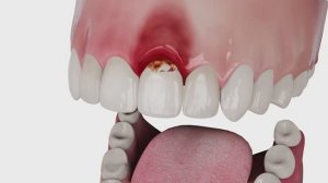 Применение средств Фитодент № 15 Острый периимплантит