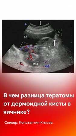 УЗИ в гинекологии: в чем разница тератомы от дермоидной кисты в яичнике?