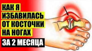 Шишка на большом пальце ноги лечение форум 👍 Вальгусстоп крем ⭐