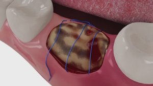 Применение средств Фитодент № 16 Хирургическое купирование послеоперационных осложнений