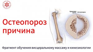 Остеопороз, причина. Фрагмент обучения висцеральному массажу и кинезиологии