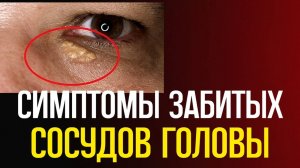 10 ПРИЗНАКОВ ЗАБИТЫХ СОСУДОВ ГОЛОВЫ
