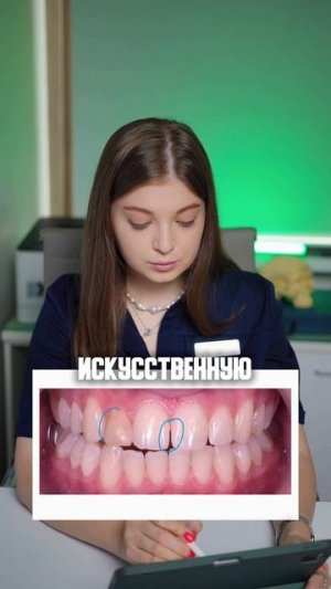 Зубы “разъехались“ после брекетов. Повторное лечение прикуса у Булычевой Д.С.