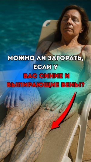Большие вены на ногах? Не выходите на солнце, пока…
