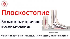 Плоскостопие. Возможные причины возникновения. Фрагмент обучения