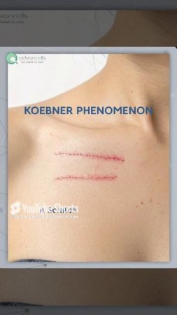 Ever wonder if your skin has a secret "copycat" mode? | #KoebnerPhenomenon #Advancells #StemCells
