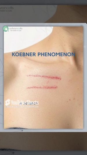 Ever wonder if your skin has a secret "copycat" mode? | #KoebnerPhenomenon #Advancells #StemCells