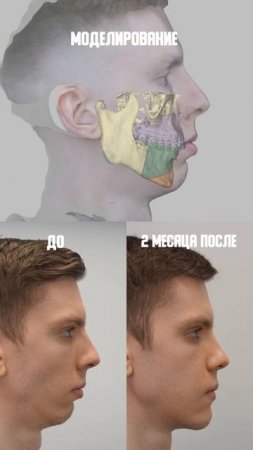 Ортогнатическая хирургия: моделирование vs реальный результат операции у челюстно-лицевого хирурга