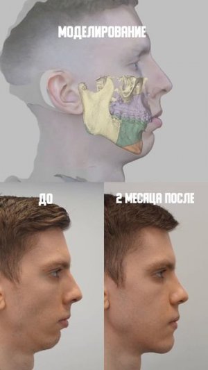 Ортогнатическая хирургия: моделирование vs реальный результат операции у челюстно-лицевого хирурга